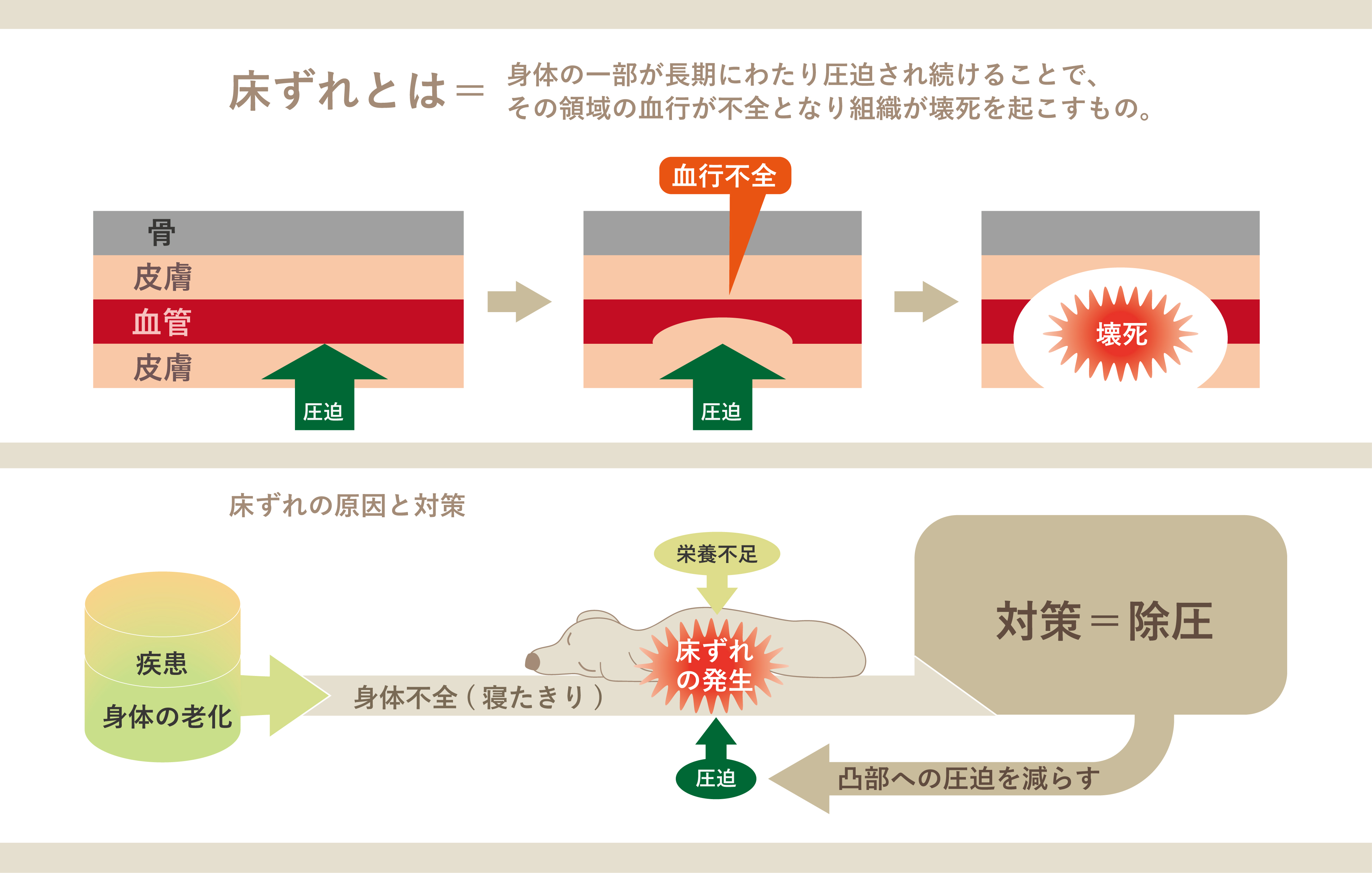11-床ずれとは